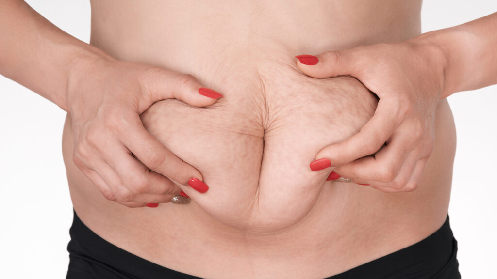 abdomen after pregnancy